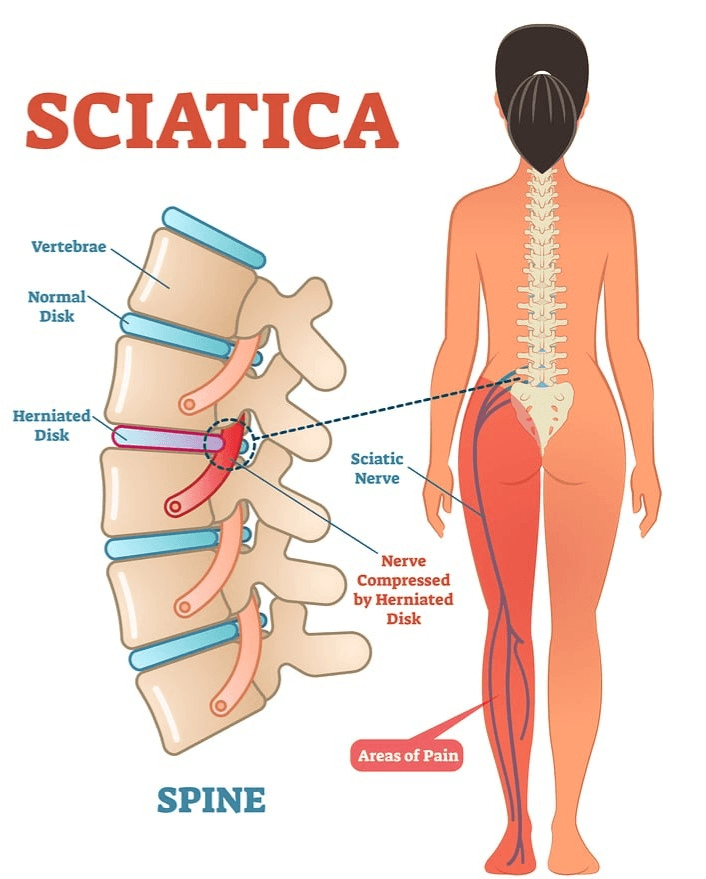 Diagram showing sciatica affecting spine and nerve areas.